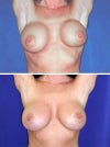 these are NOT my breast but this is how they look when i lift my hands. They are round, very fake looking.