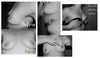 What I have, Lifting skin demonstrates where I want nipple to be and shape I want