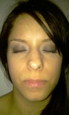 deviated septum