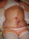 This was a few days post op.