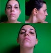 AFTER SURGERY