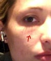 The small under eye dent that has started to show up after 9 months. Filler wearing off in just this area? My bruise from my first dermal filler was in this area... could that have something to do with why it is wearing off like this over a year+ later? I have moved states, so I cant visit the same doc who treated me. Was uniform and looked great for 9 months though.