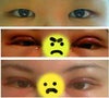 First photo is my original eyes. 
Second photo is the second day of surgery.
Third photo is after 1 week.