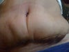 Front- 4 weeks post op