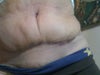 Front 3 - 4 weeks post op