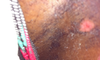 This is the most recent photo - as you can see the top is peeling and underneath there is really pink skin - this is not pussy at this stage, and is quite dry...