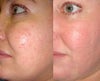 Microdermabrasion Acne Scars