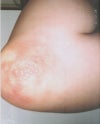 Picture of the type of rash I get with certain drug injections and/or medications. What I have now on my cheeks after Radiesse is similar, but not as bad, as I recognized sooner and got prescription for antiviral sooner before it spread along the nerve pathways like it usually does.