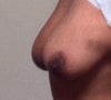 Side pic breast