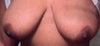 Front Breast