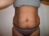abdominal