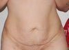 Front View before Tummy tuck