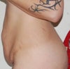Side view before Tummy tuck