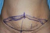 Drawings of my Tummy tuck