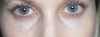 under eye area