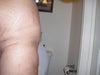 in this photo you can see a hole on my side, it;s been 7 week since i had my surgery.