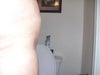 another one from the same side. unhappy. what should I do about the hole that I have now?