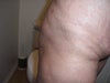 here where you see all my lumps all over, what should I do. I"m not happy with the procedure at all.