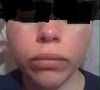 Skin is sensitiv & face feels like its constantly on fire and am embarased/hate the way I look; RX meds have somewhat helped a tiny bit but aren't enuf-need more advanced options to drasticaly improve my facial apperance! 