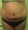 I have had 3 c-sections; 1 previous tummy tuck and lipo after my first c-section. My last c-section was Nov. 2010 and we're not having anymore children (positive this time!)