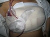 3 days after 1st surgery, 2nd surgery done for hematoma with drain put in.