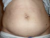 8wks post-op