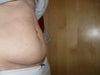 8wks post-op