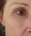 lumps under right eye