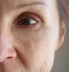 lumps under left eye