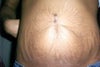 umbilical hernia repair in 2003 by a general surgeon 6 months after childbirth. what are my options i dont wanna have more long scars