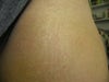 Stretch marks on my thighs/hips