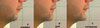considering a chin augmentation and would prefer an implant over bone cutting
