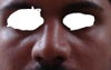 51 days after rhinoplasty