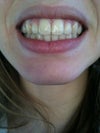 After braces for 15 months.