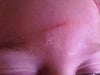 a few days after the incident (after she picked the scab off)