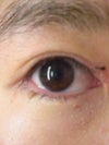 Correct eye