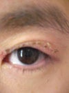 Incorrect eye