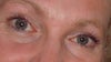 Before restylane