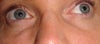 2 weeks after restylane
