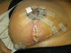 another angle of the right breast