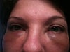 48hr after injections