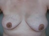 Lumpectomy/Radiation on R Breast