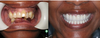Smile Makeover Before and After Photos