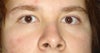 My eyes with the epicanthal folds. The left side is much stronger then the right