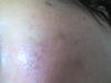 EVIS MD Red Light platinum facial system