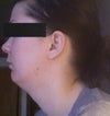small chin that is characteristic of the connective tissue disorder