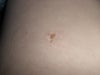 scar with pigment
