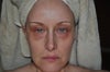 9 weeks post fraxel repair. Hyperpigmentation and scarring (under left eye).