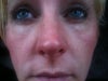 flat sunken under eye hollows