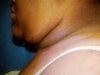 Before neck lipo pic